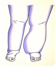 Patologia edemului limfatic