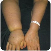 Patologia edemului limfatic