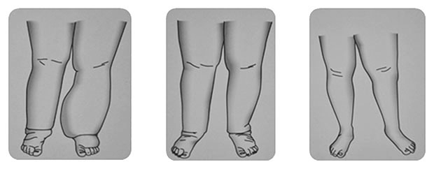 Patologia edemului limfatic